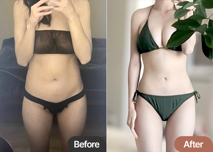 Before and after abdominal liposuction of Rapunjel in Korea—visible improvement in waistline and belly contour.
