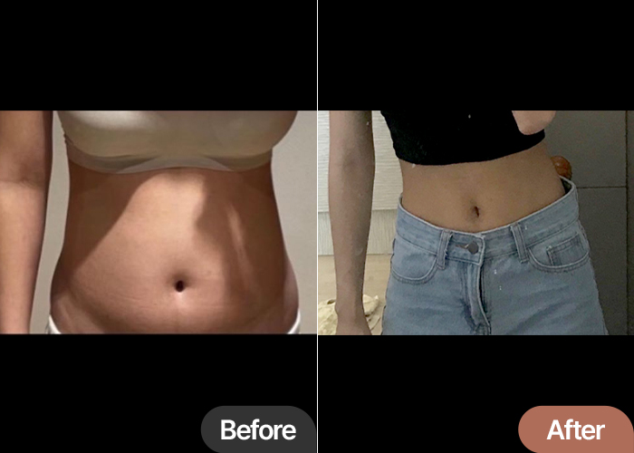 abdominal-liposuction-thumbnail-ureureu