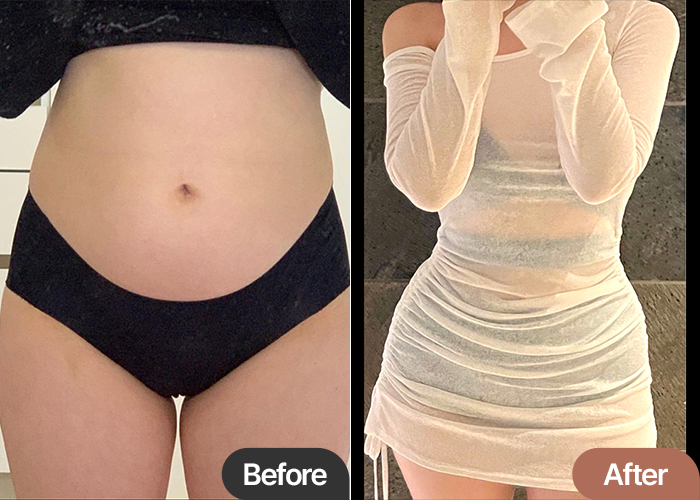 abdominal-liposuction-thumbnail-wwwwer