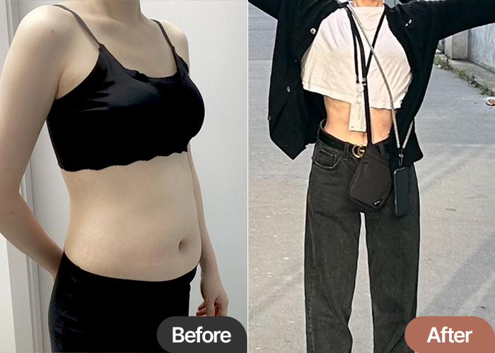 abdominal-liposuction-thumbnail-yeonjjangiya