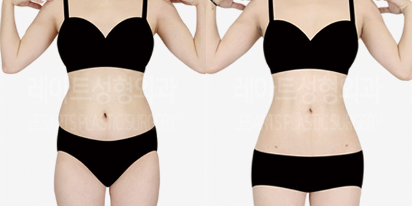 abdominal_liposuction_01_thumbnail_240819