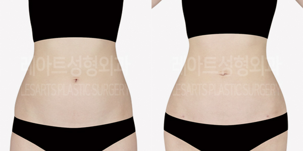 abdominal_liposuction_01_thumbnail_240904