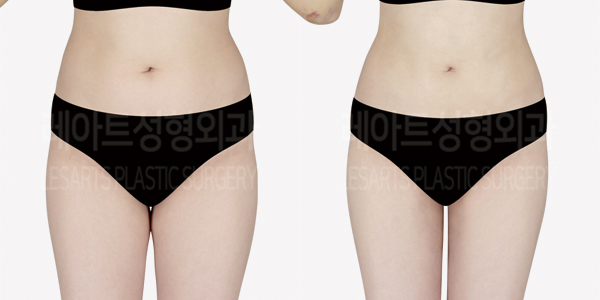 abdominal_liposuction_01_thumbnail_240905