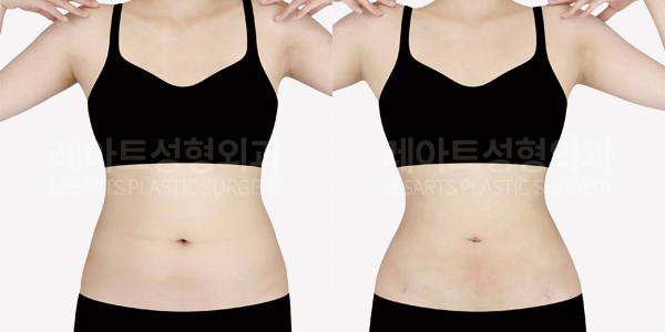 abdominal_liposuction_01_thumbnail_241125