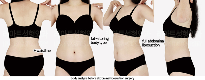 abdominal_liposuction_02_01_240819