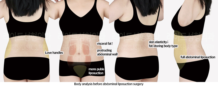 abdominal_liposuction_02_01_240823