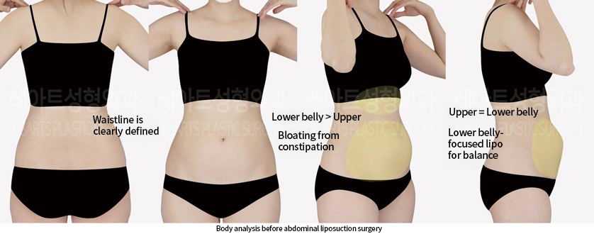 abdominal_liposuction_02_01_240904
