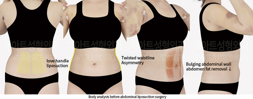 abdominal_liposuction_02_01_240905