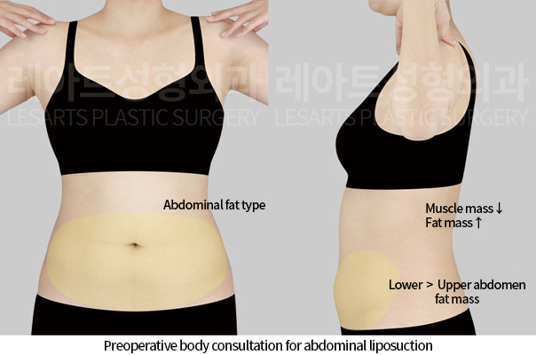 abdominal_liposuction_02_01_241125