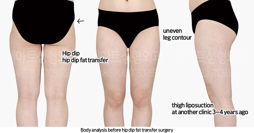 abdominal_liposuction_02_02_240819