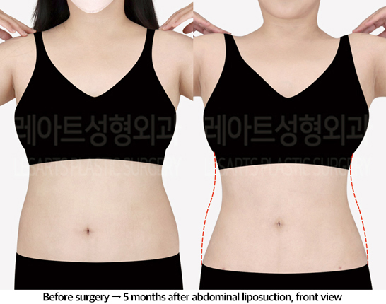 abdominal_liposuction_02_02_240823