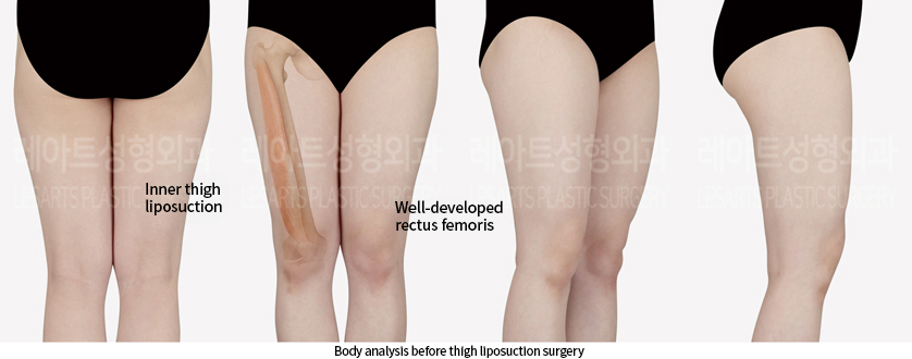 abdominal_liposuction_02_02_240905