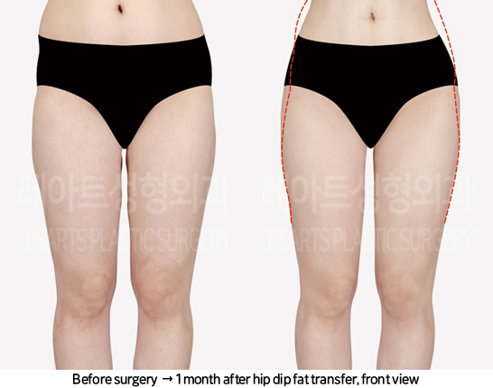 abdominal_liposuction_02_03_240819