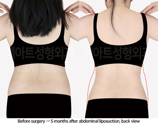 abdominal_liposuction_02_03_240823