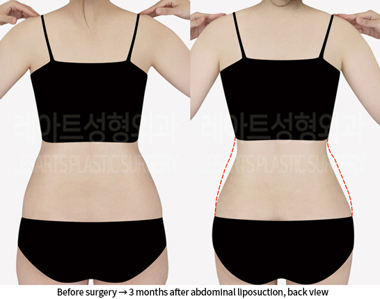 abdominal_liposuction_02_03_240904