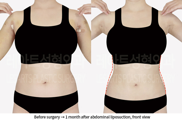 abdominal_liposuction_02_03_240905
