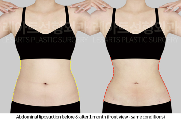 abdominal_liposuction_02_03_241125