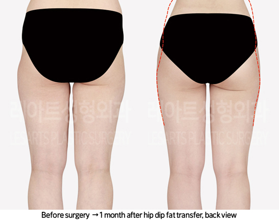abdominal_liposuction_02_04_240819