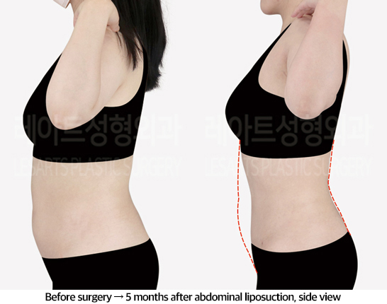 abdominal_liposuction_02_04_240823