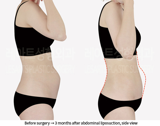 abdominal_liposuction_02_04_240904
