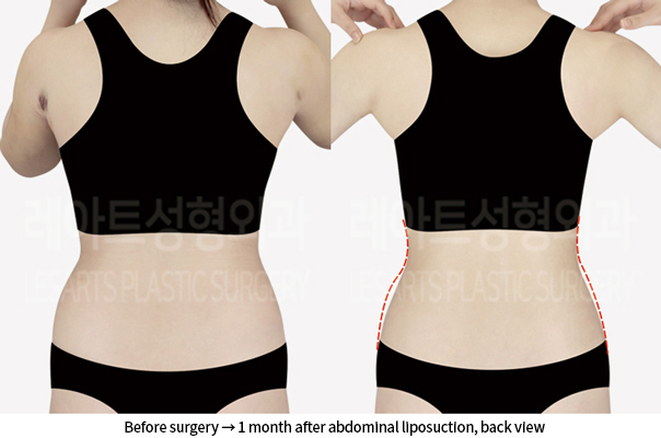 abdominal_liposuction_02_04_240905