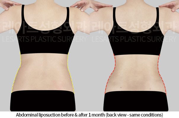 abdominal_liposuction_02_04_241125