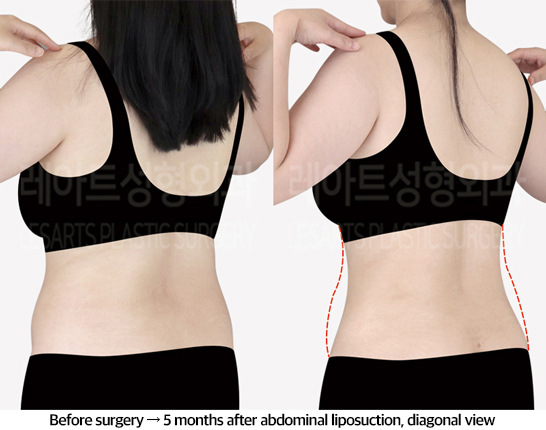 abdominal_liposuction_02_05_240823