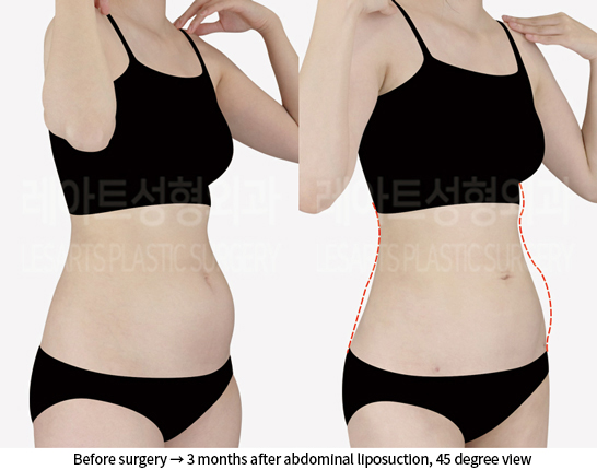 abdominal_liposuction_02_05_240904