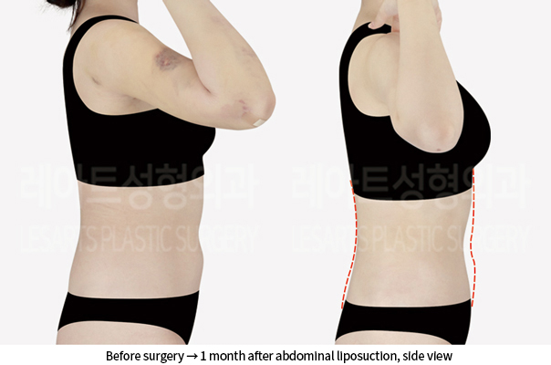 abdominal_liposuction_02_05_240905