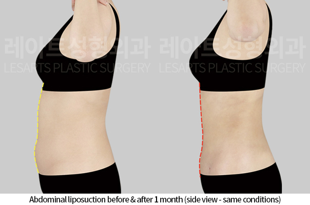 abdominal_liposuction_02_05_241125