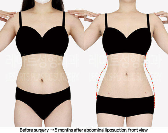 abdominal_liposuction_02_06_240819