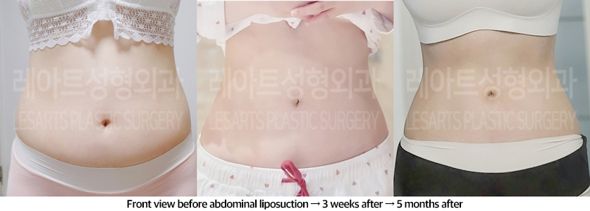 abdominal_liposuction_02_06_240823