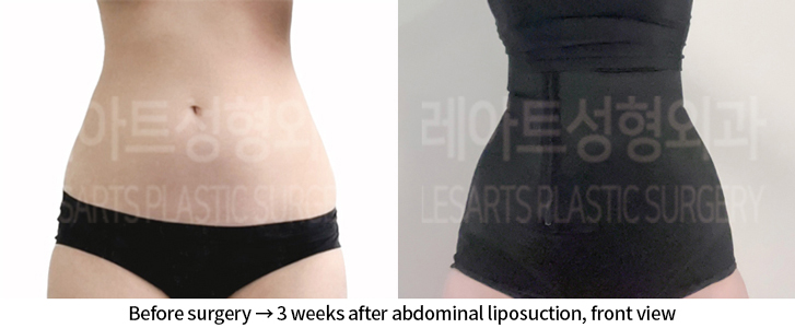 abdominal_liposuction_02_06_240904
