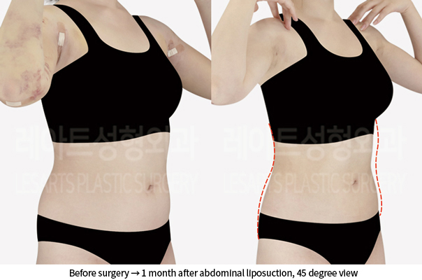 abdominal_liposuction_02_06_240905