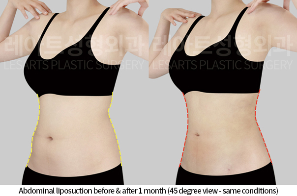 abdominal_liposuction_02_06_241125