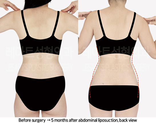 abdominal_liposuction_02_07_240819
