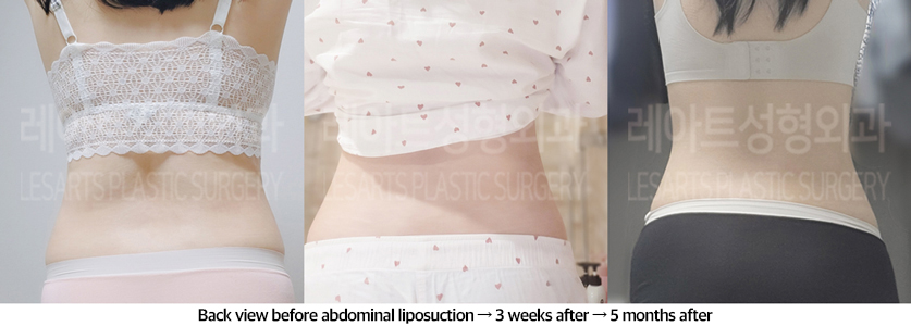 abdominal_liposuction_02_07_240823