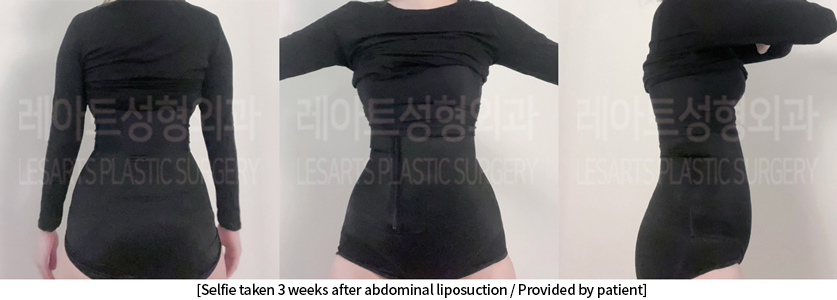 abdominal_liposuction_02_07_240904