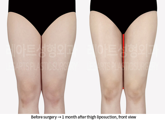 abdominal_liposuction_02_07_240905