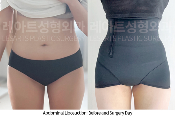 abdominal_liposuction_02_07_241125