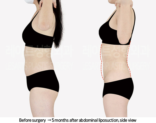 abdominal_liposuction_02_08_240819
