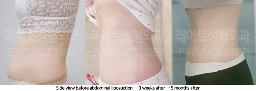 abdominal_liposuction_02_08_240823