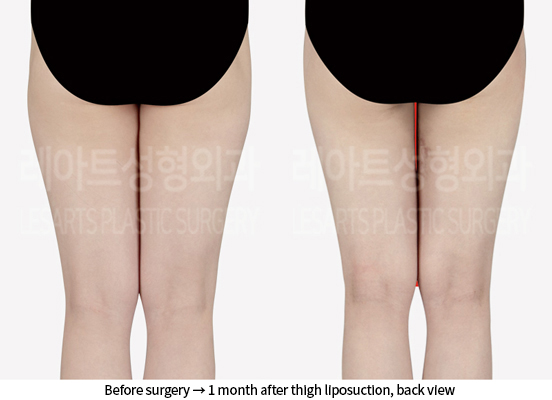 abdominal_liposuction_02_08_240905