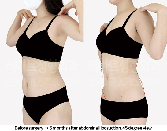 abdominal_liposuction_02_09_240819