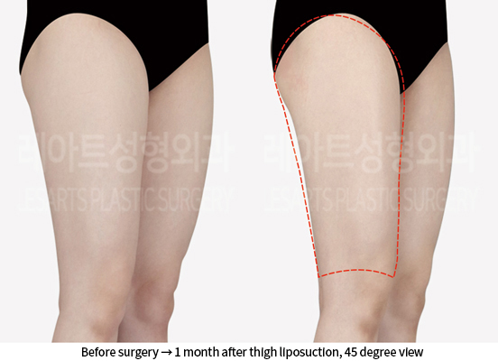 abdominal_liposuction_02_10_240905