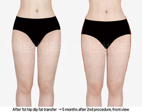 abdominal_liposuction_02_11_240819