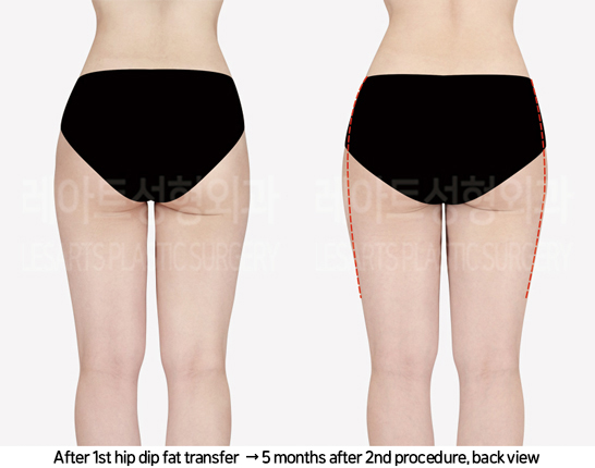 abdominal_liposuction_02_13_240819