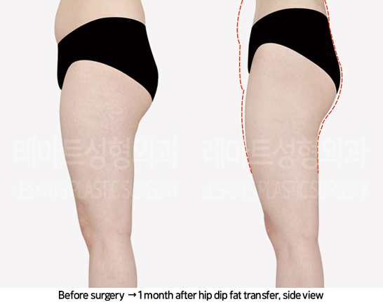 abdominal_liposuction_02_14_240819