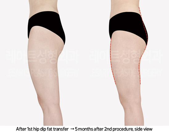 abdominal_liposuction_02_15_240819