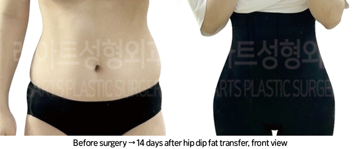 abdominal_liposuction_02_16_240819
